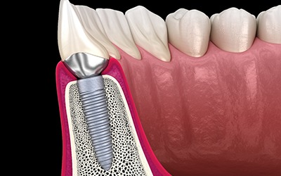 Illustration of dental implant in Wayland, MA in jawbone