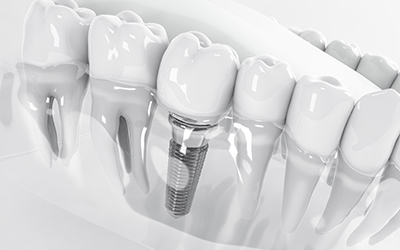 Illustration of dental implant in Wayland, MA in plastic model of mouth