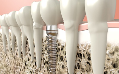 Render of dental implant in Wayland, MA in jaw