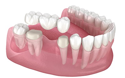 Illustration of a dental bridge for the lower arch