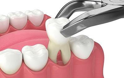 Illustration of process for tooth extraction in Wayland, MA