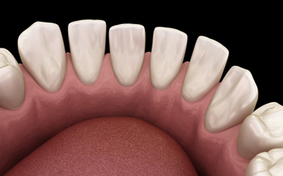 Illustration of teeth with gaps between them