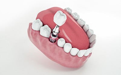 Illustration of dental crown and dental implant in lower arch