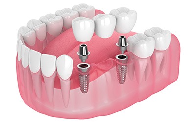 Illustration of dental bridge being attached to dental implants