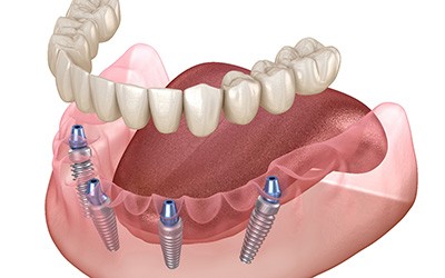 Illustration of dentures being attached to four dental implants