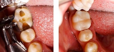 A tooth before and after receiving multiple dental fillings.