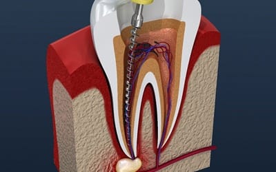 Diagram of root canal therapy in Wayland.