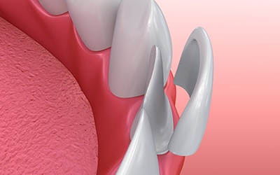 diagram showing the process of getting porcelain veneers in Wayland