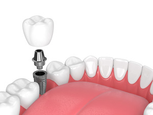 Crown, abutment, and dental implant post in jaw