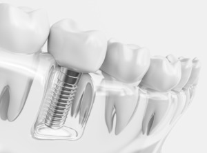Illustration of a dental implant in a plastic model