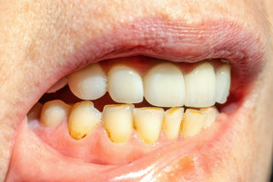 Close-up of smile with stained lower teeth