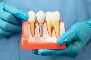 Dentist with gloved hands holding model of dental implant